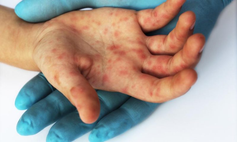 Pernambuco registra primeiro caso de varíola dos macacos em mulher