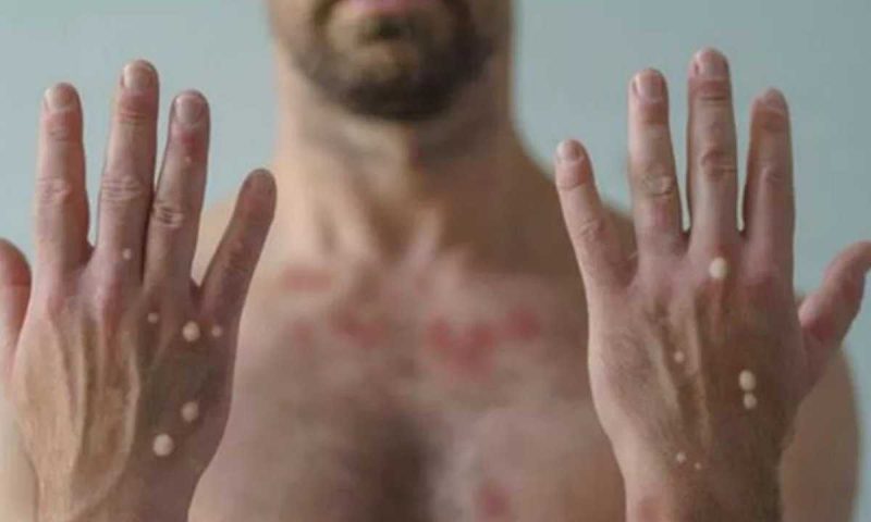 OMS declara varíola dos macacos como emergência de saúde global