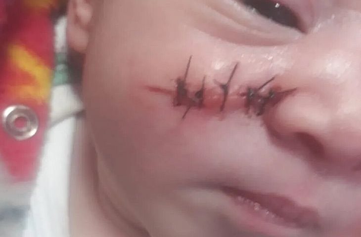Bebê tem rosto cortado durante cesárea em MG e leva 5 pontos, relata pai