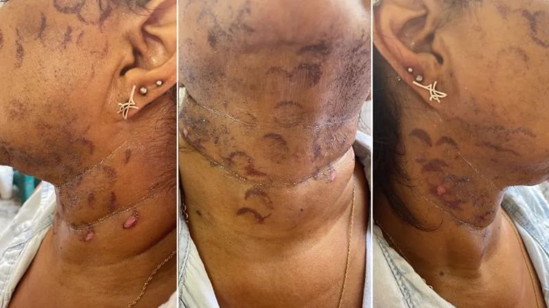 Mulher sofre queimaduras no rosto após tratamento de depilação na Espaço Laser