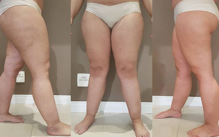 O que é lipedema, inflamação que se confunde com celulite e causa dor