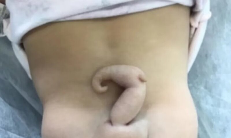 Bebê brasileira nasce com ‘cauda’ de 6 cm