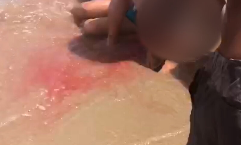 Adolescente mordida por tubarão em Piedade tem braço amputado