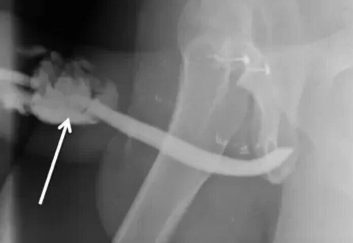 Posição sexual perigosa faz homem quebrar o pênis em 3 lugares diferentes