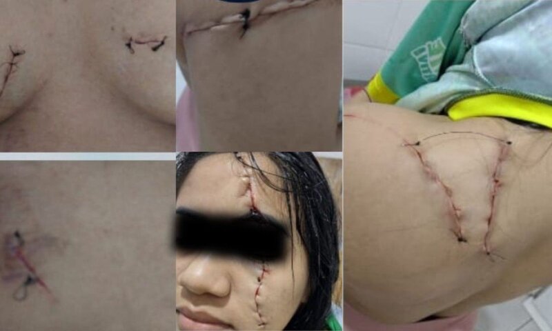 Mulher tem seios e rosto cortados a bisturi por ex-amante do marido ao sair de academia