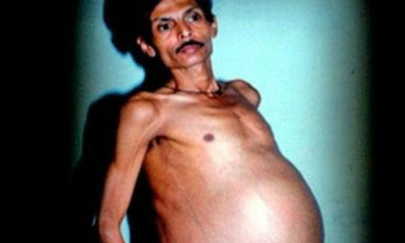 Homem descobre que viveu com irmão dentro do corpo por 36 anos