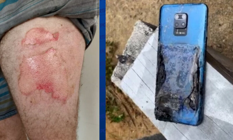 Celular explode dentro do bolso e homem tem a perna queimada