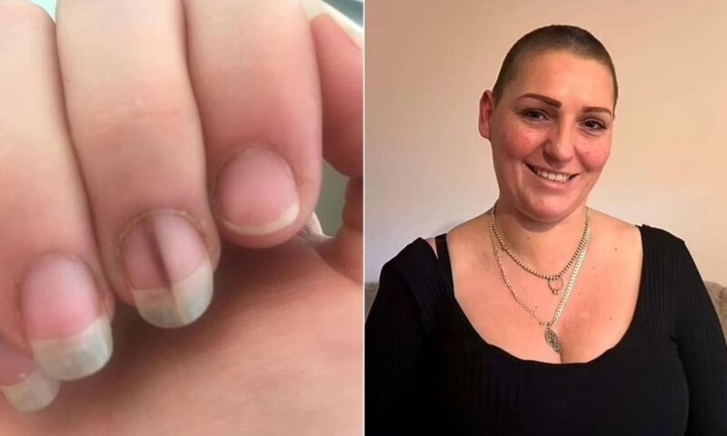 Mulher descobre tipo raro e agressivo de câncer de pele após notar linha escura na unha