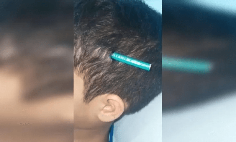 Menino de nove anos fica com lápis cravado na cabeça após ataque de colega de classe