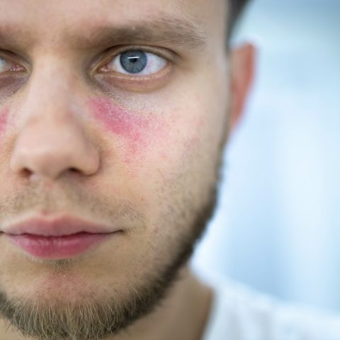 Medicamentos contra lúpus são incluídos no rol de cobertura dos planos de saúde