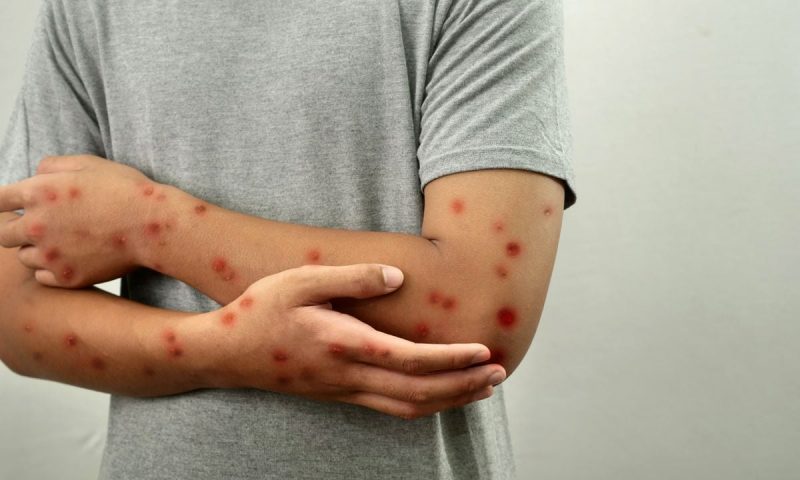 Caso de Mpox é confirmado em Porto Alegre; autoridades reforça orientações