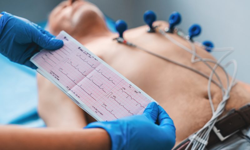 Eletrocardiograma pode ser solicitado mesmo sem sintomas aparentes; entenda