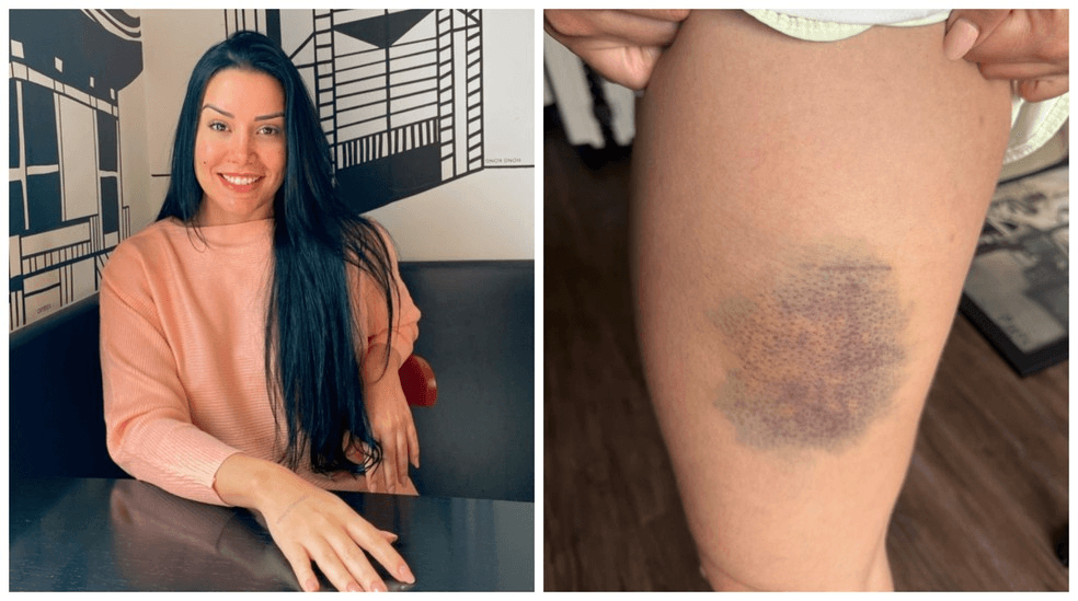Nutricionista que lutou contra agressor para não ser estuprada revela que treinou muay thai, boxe, jiu-jítsu e defesa pessoal