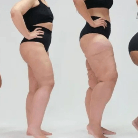 Lipedema: excesso de gordura nas pernas é confundida com obesidade