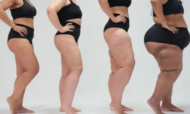 Lipedema: excesso de gordura nas pernas é confundida com obesidade
