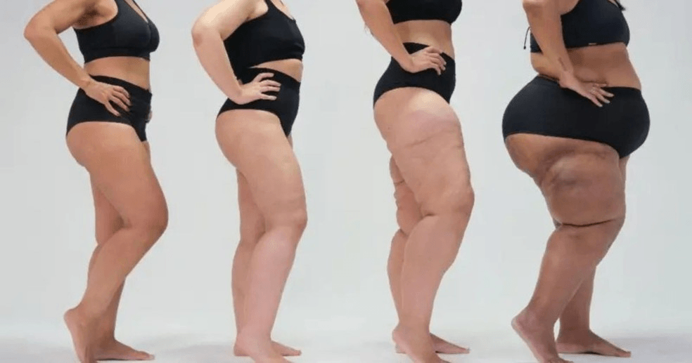 Lipedema: excesso de gordura nas pernas é confundida com obesidade